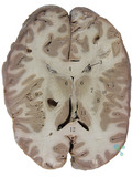 中枢神经系统—大脑水平切.jpg