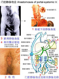 血管-门腔静脉交通.jpg