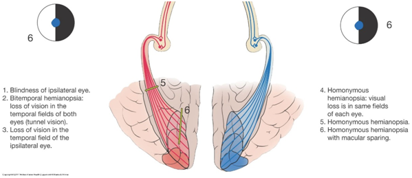 5),将造成左(同)侧(ipsilateral)内/ 鼻侧半盲(nasal hemianopsia)