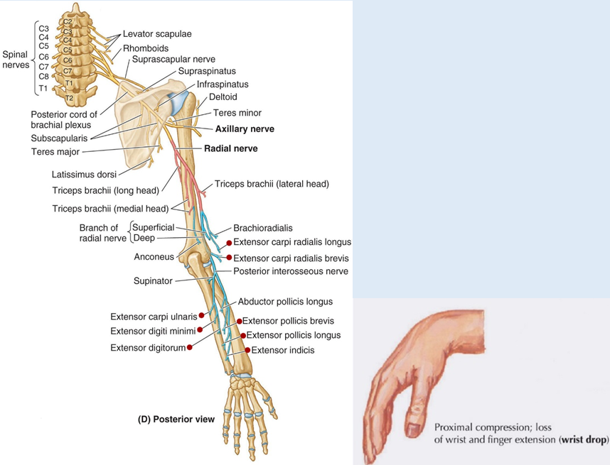 指伸肌皆失用,因此手腕无法伸展(extension),可确定为桡神经受伤所致