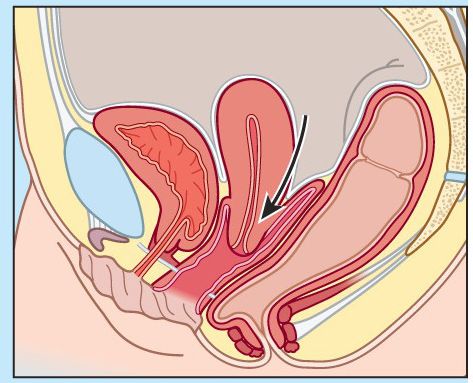 子宫圆韧带解剖图片