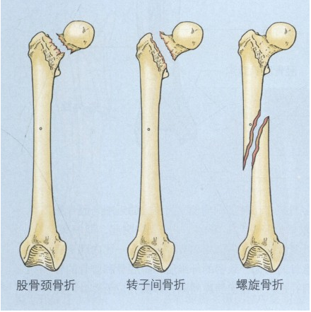 有时股骨体也会发生螺旋形骨折,可能为粉碎性骨折且骨折块发生移位