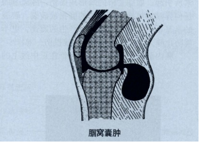 膕窩囊腫是由膝關節滑膜形成的疝,其間充滿液體;或者是由腓腸肌囊或半