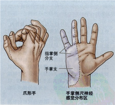 內收力減弱,在腕關節屈曲時,由於橈側腕屈肌(該肌由正中神經支配)的