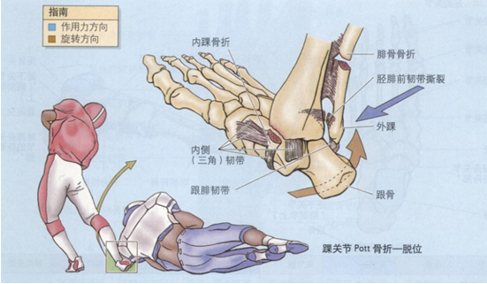 強健的內側韌帶受到牽拉常可導致內踝的撕脫.